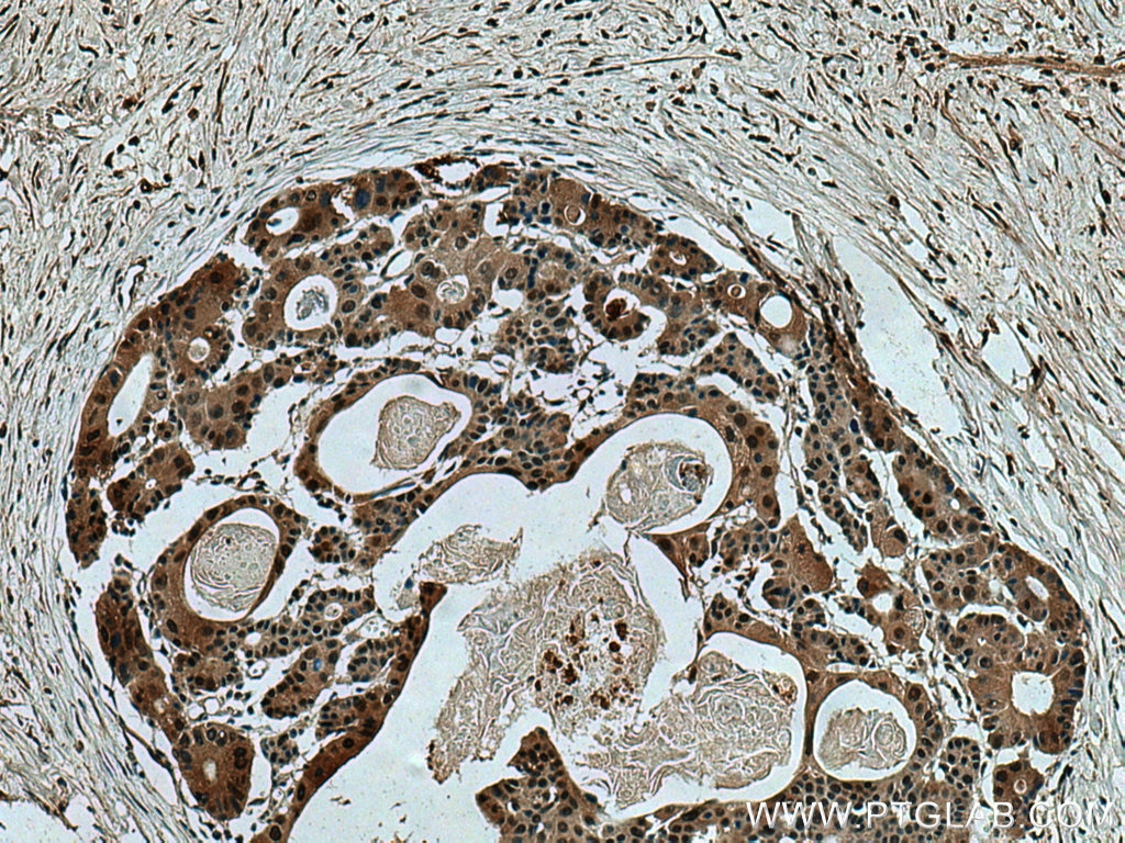 Immunohistochemistry (IHC) staining of human colon cancer tissue using RNF34 Polyclonal antibody (10629-1-AP)