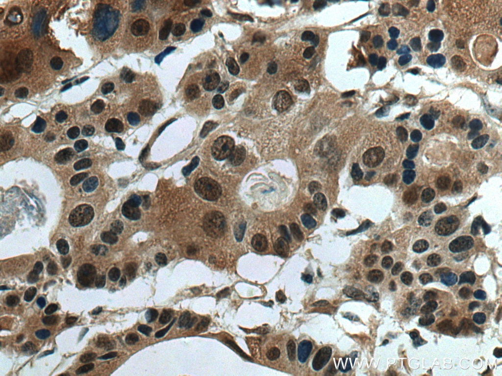 Immunohistochemistry (IHC) staining of human colon cancer tissue using RNF34 Polyclonal antibody (10629-1-AP)