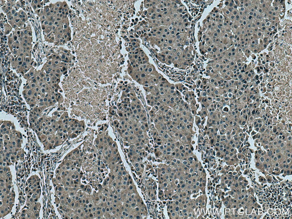 Immunohistochemistry (IHC) staining of human breast cancer tissue using RNF34 Polyclonal antibody (10629-1-AP)