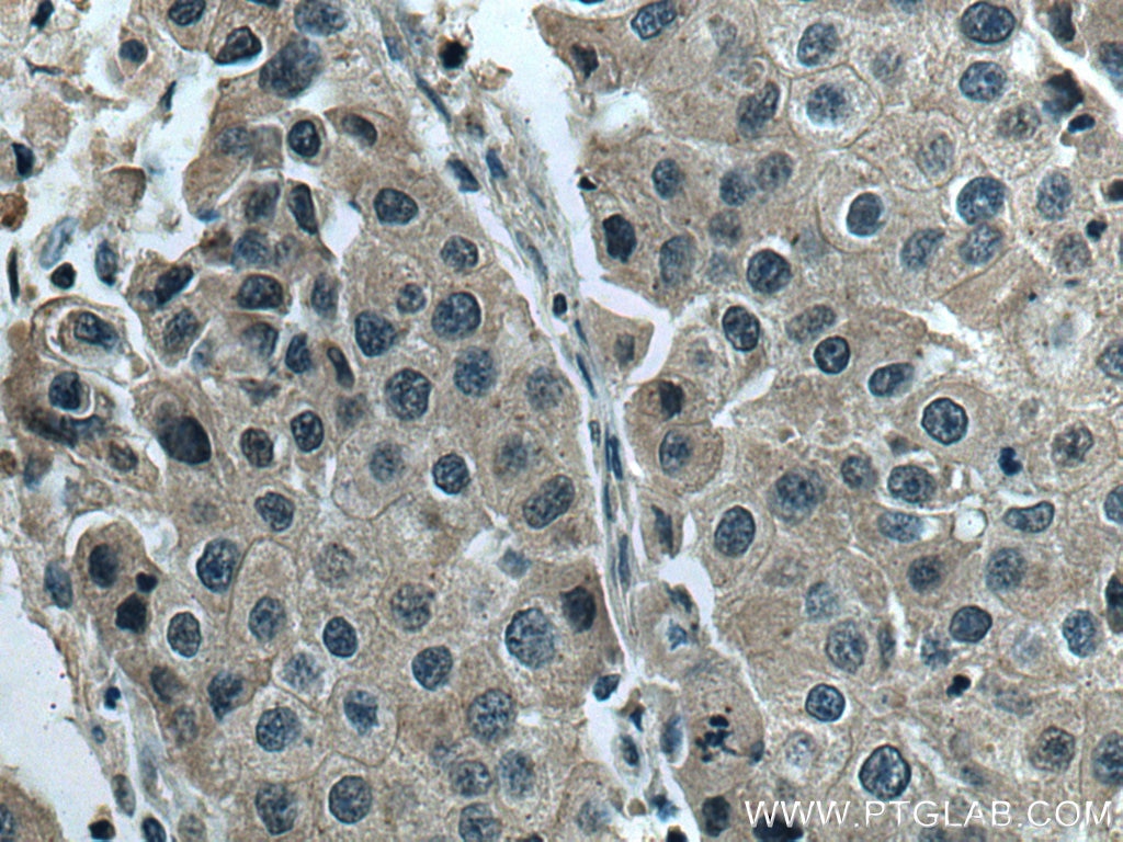 Immunohistochemistry (IHC) staining of human breast cancer tissue using RNF34 Polyclonal antibody (10629-1-AP)