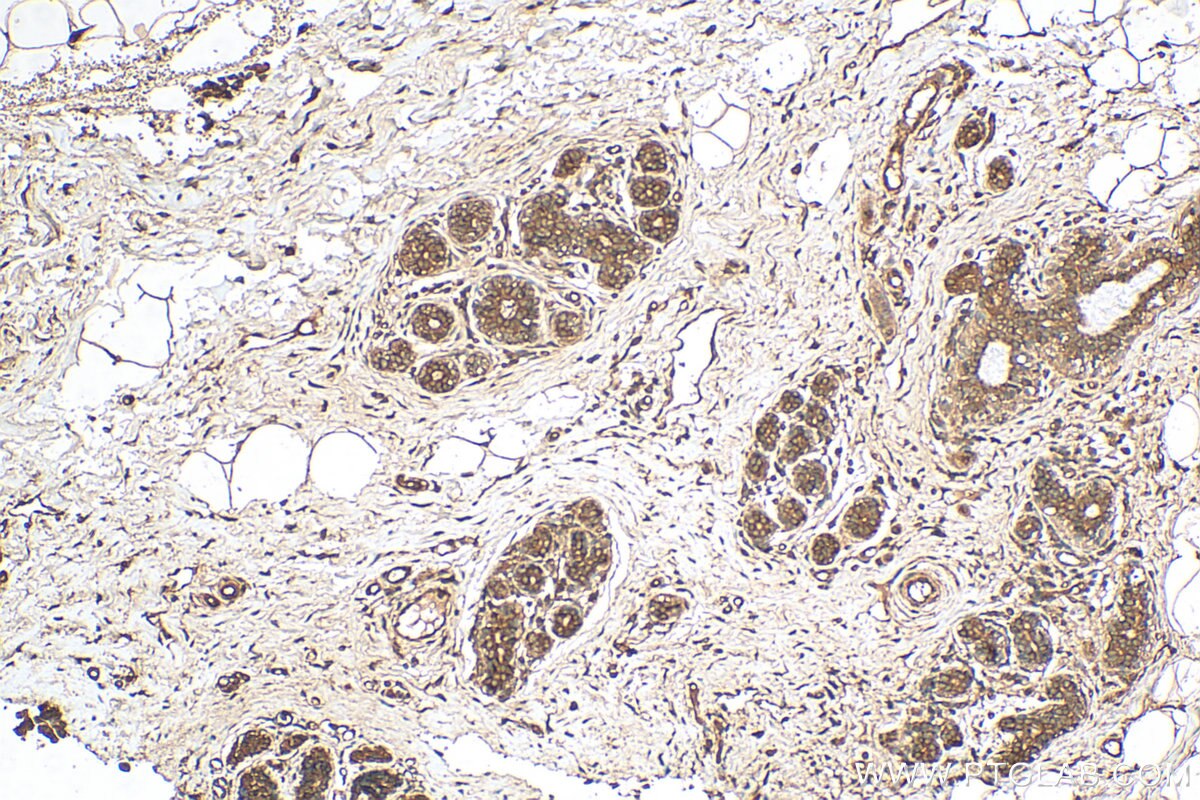 Immunohistochemistry (IHC) staining of human breast cancer tissue using RNF34 Polyclonal antibody (10629-1-AP)