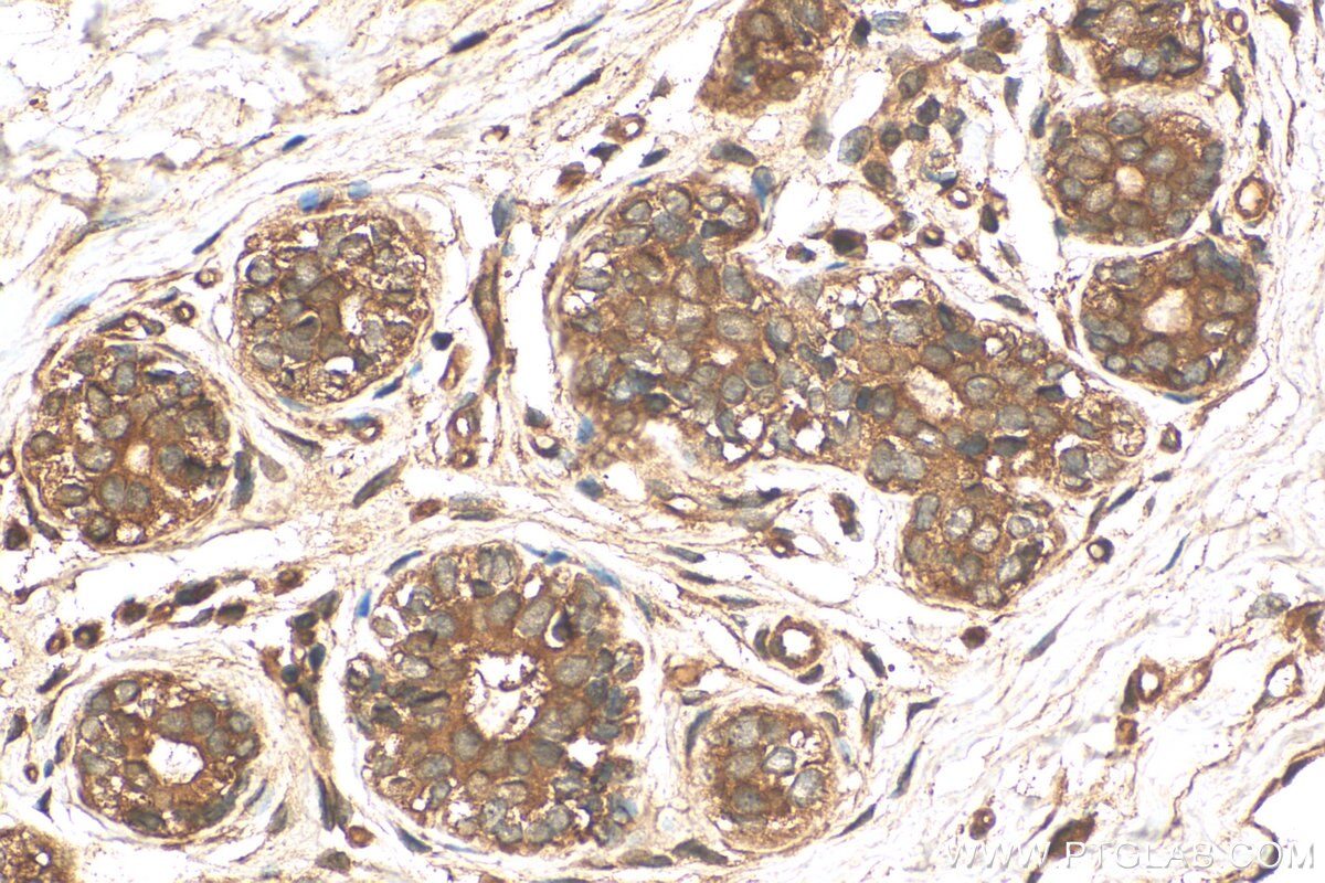 Immunohistochemistry (IHC) staining of human breast cancer tissue using RNF34 Polyclonal antibody (10629-1-AP)