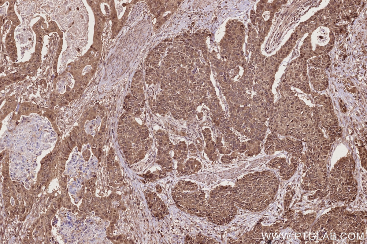 Immunohistochemistry (IHC) staining of human stomach cancer tissue using RNF34 Polyclonal antibody (10629-1-AP)