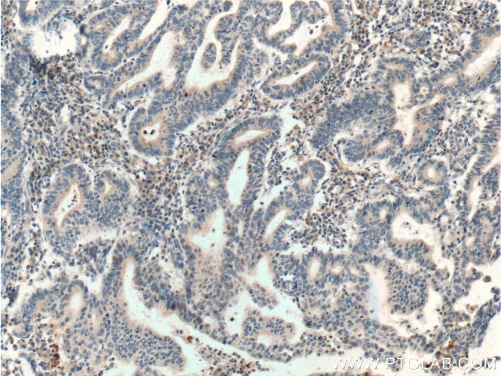 Immunohistochemistry (IHC) staining of human endometrial cancer tissue using RNF38 Polyclonal antibody (25132-1-AP)
