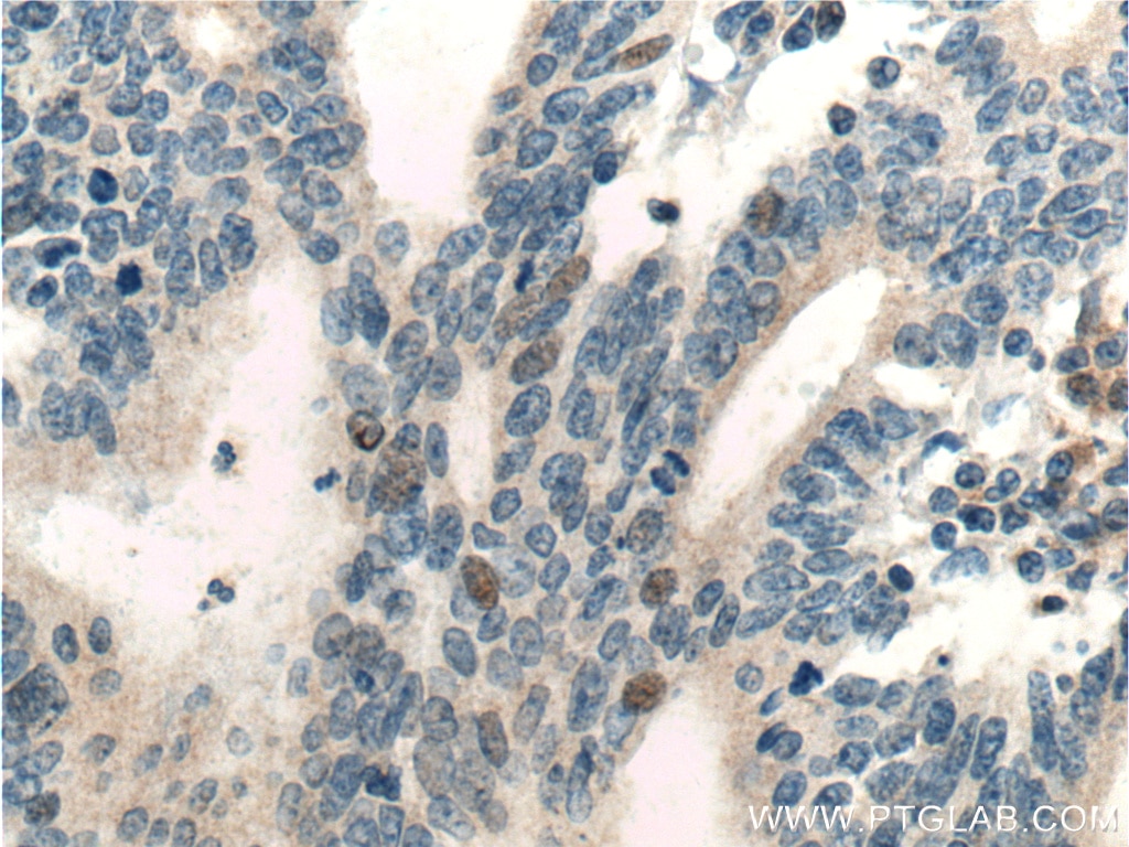 Immunohistochemistry (IHC) staining of human endometrial cancer tissue using RNF38 Polyclonal antibody (25132-1-AP)