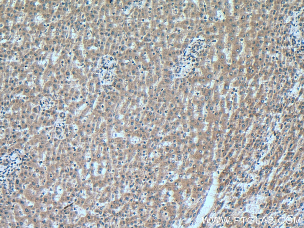 Immunohistochemistry (IHC) staining of human liver cancer tissue using RNF41 Polyclonal antibody (17233-1-AP)