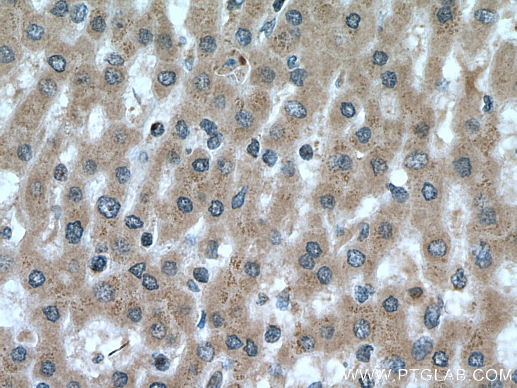 Immunohistochemistry (IHC) staining of human liver cancer tissue using RNF41 Polyclonal antibody (17233-1-AP)