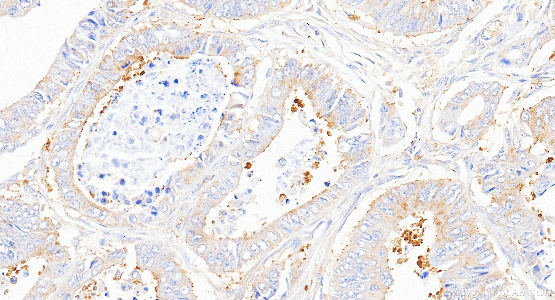 IHC staining of human colon cancer using 86740-1-RR Immunohistochemistry (IHC) staining of human colon cancer tissue using RNF43 Recombinant monoclonal antibody (86740-1-RR)