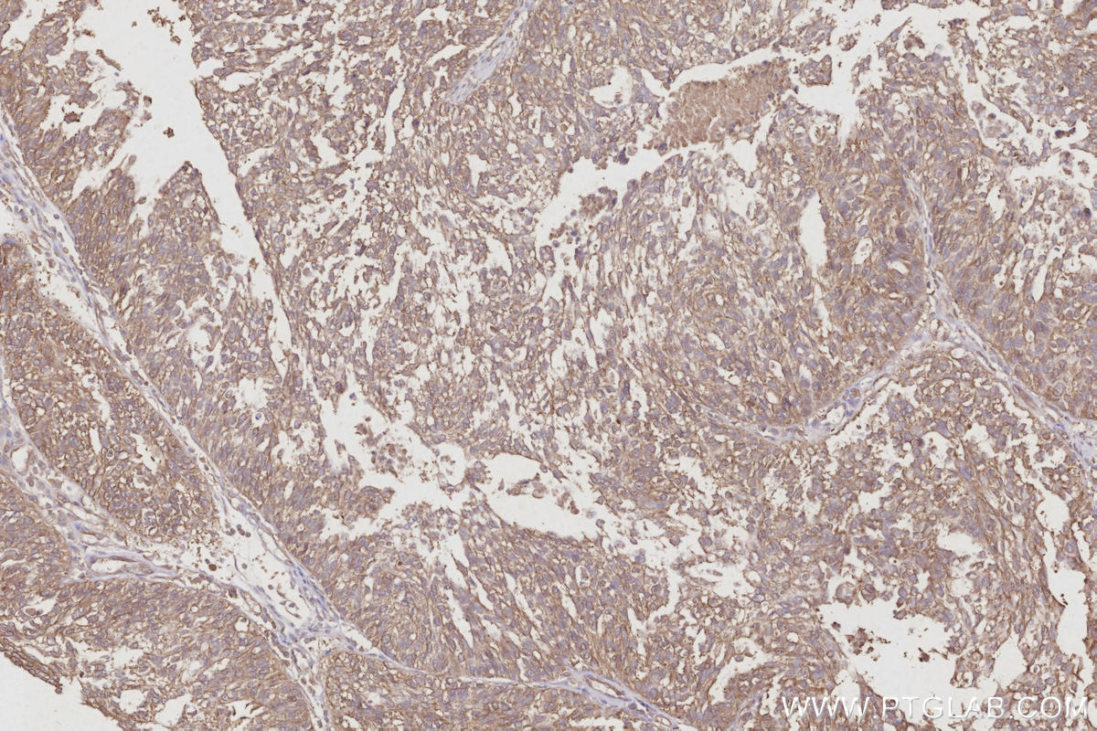 Immunohistochemistry (IHC) staining of human ovary cancer tissue using RNF7 Polyclonal antibody (11905-1-AP)
