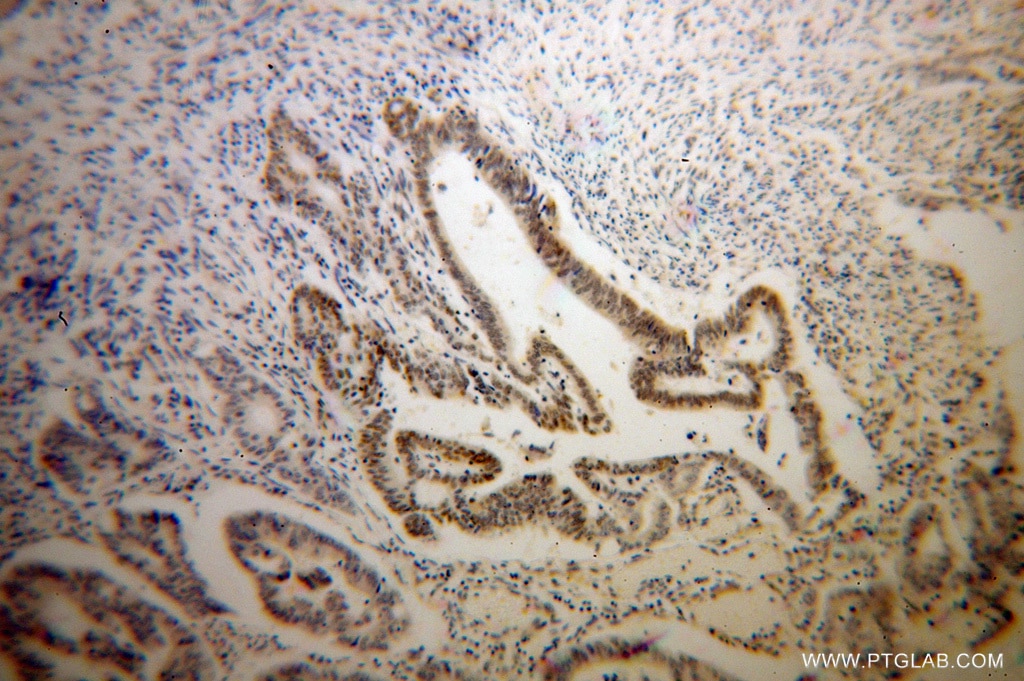 IHC staining of human colon cancer using 13743-1-AP