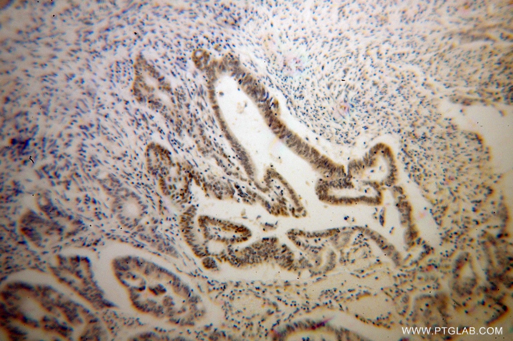 Immunohistochemistry (IHC) staining of human colon cancer tissue using RNMT Polyclonal antibody (13743-1-AP)