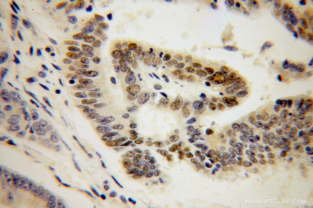 Immunohistochemistry (IHC) staining of human colon cancer tissue using RNMT Polyclonal antibody (13743-1-AP)