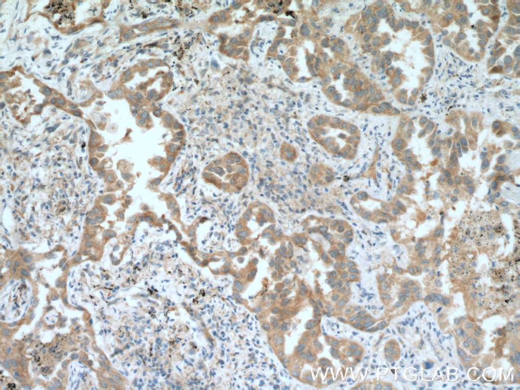 Immunohistochemistry (IHC) staining of human lung cancer tissue using RNPEP Polyclonal antibody (14764-1-AP)