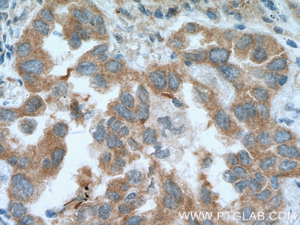 Immunohistochemistry (IHC) staining of human lung cancer tissue using RNPEP Polyclonal antibody (14764-1-AP)