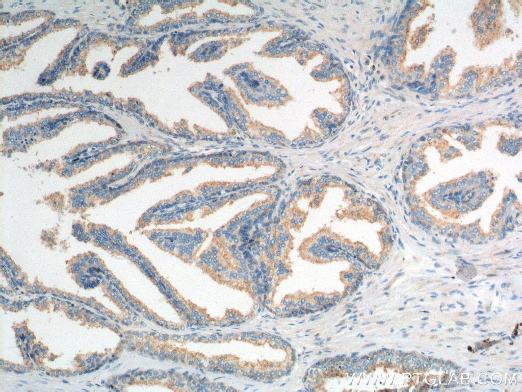 Immunohistochemistry (IHC) staining of human prostate hyperplasia tissue using ROBO2 Polyclonal antibody (19986-1-AP)