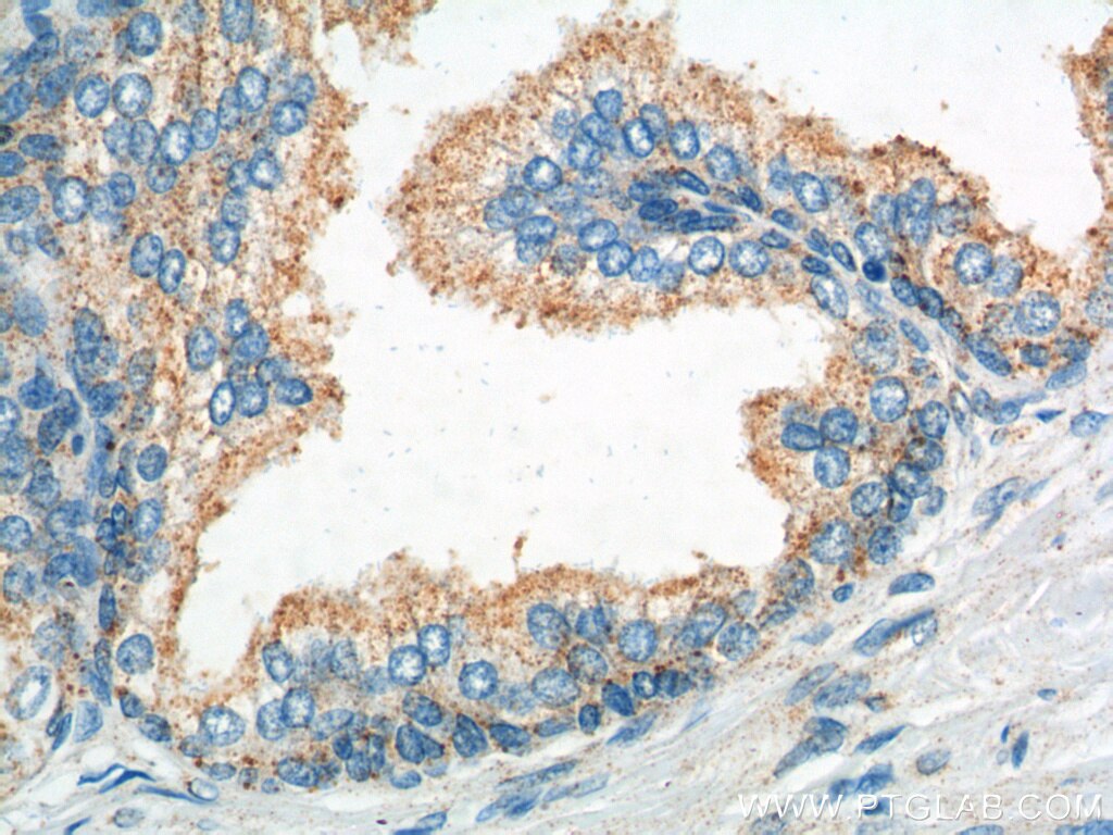 Immunohistochemistry (IHC) staining of human prostate hyperplasia tissue using ROBO2 Polyclonal antibody (19986-1-AP)