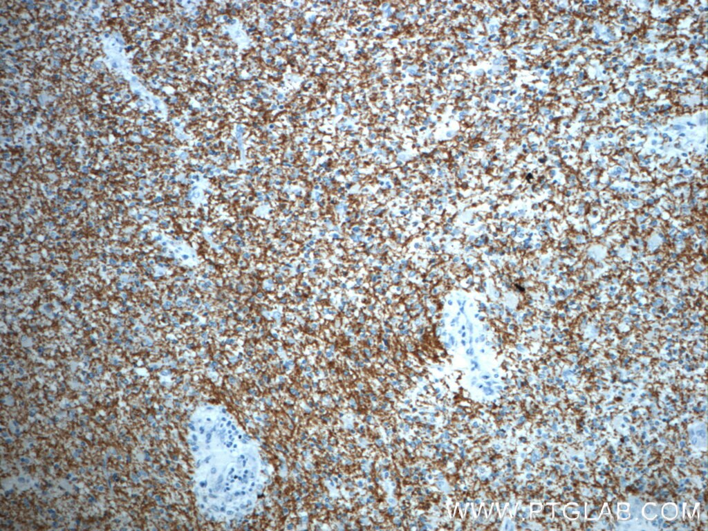 Immunohistochemistry (IHC) staining of human gliomas tissue using ROBO3-Specific Polyclonal antibody (20220-1-AP)