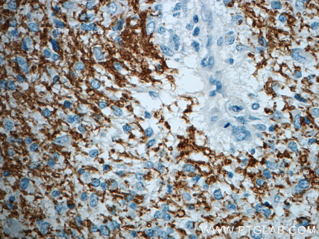 Immunohistochemistry (IHC) staining of human gliomas tissue using ROBO3-Specific Polyclonal antibody (20220-1-AP)