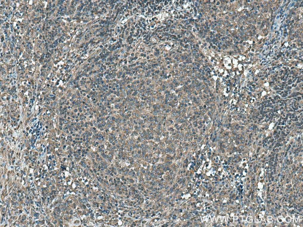 Immunohistochemistry (IHC) staining of human lymphoma tissue using ROCK1 Polyclonal antibody (21850-1-AP)