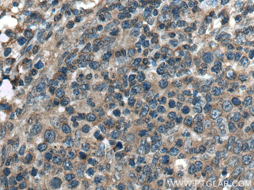 Immunohistochemistry (IHC) staining of human lymphoma tissue using ROCK1 Polyclonal antibody (21850-1-AP)