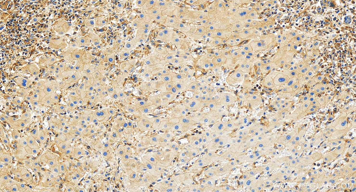 Immunohistochemistry (IHC) staining of human intrahepatic cholangiocarcinoma tissue using ROCK1 Recombinant antibody (83166-5-RR)