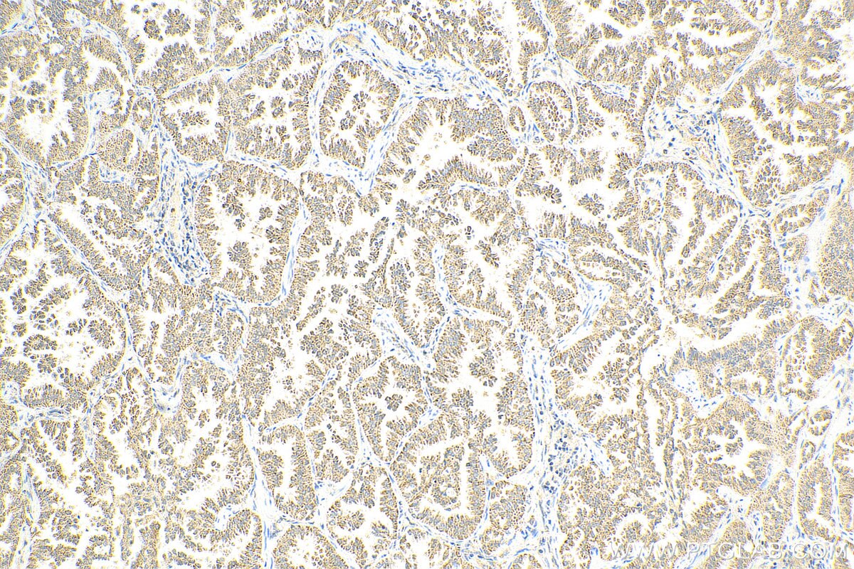 Immunohistochemistry (IHC) staining of human lung cancer tissue using ROCK1-Specific Polyclonal antibody (20247-1-AP)