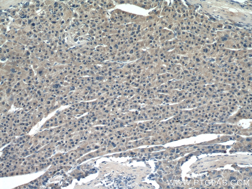 Immunohistochemistry (IHC) staining of human liver cancer tissue using ROCK2 Monoclonal antibody (66633-1-Ig)