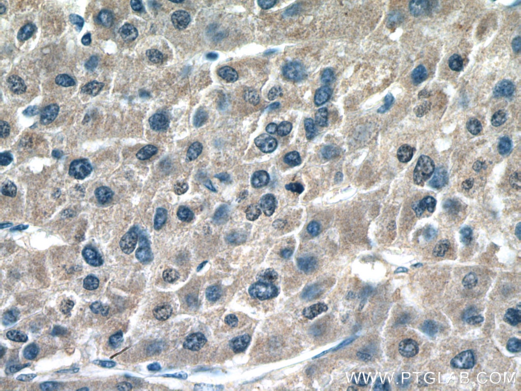 Immunohistochemistry (IHC) staining of human liver cancer tissue using ROCK2 Monoclonal antibody (66633-1-Ig)