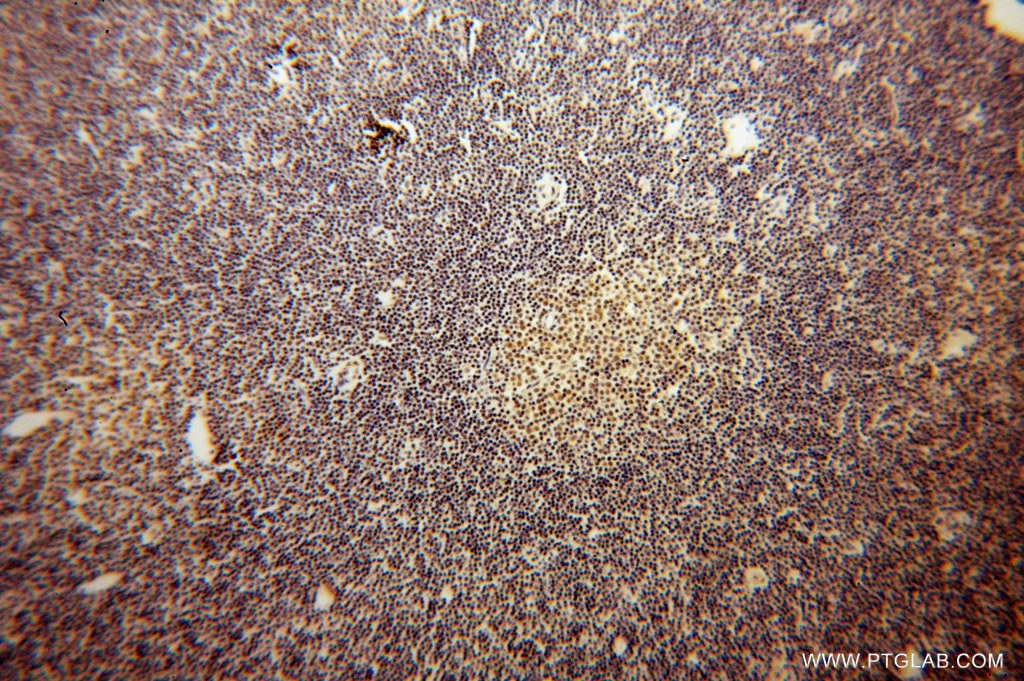 IHC staining of human lymphoma using 14027-1-AP