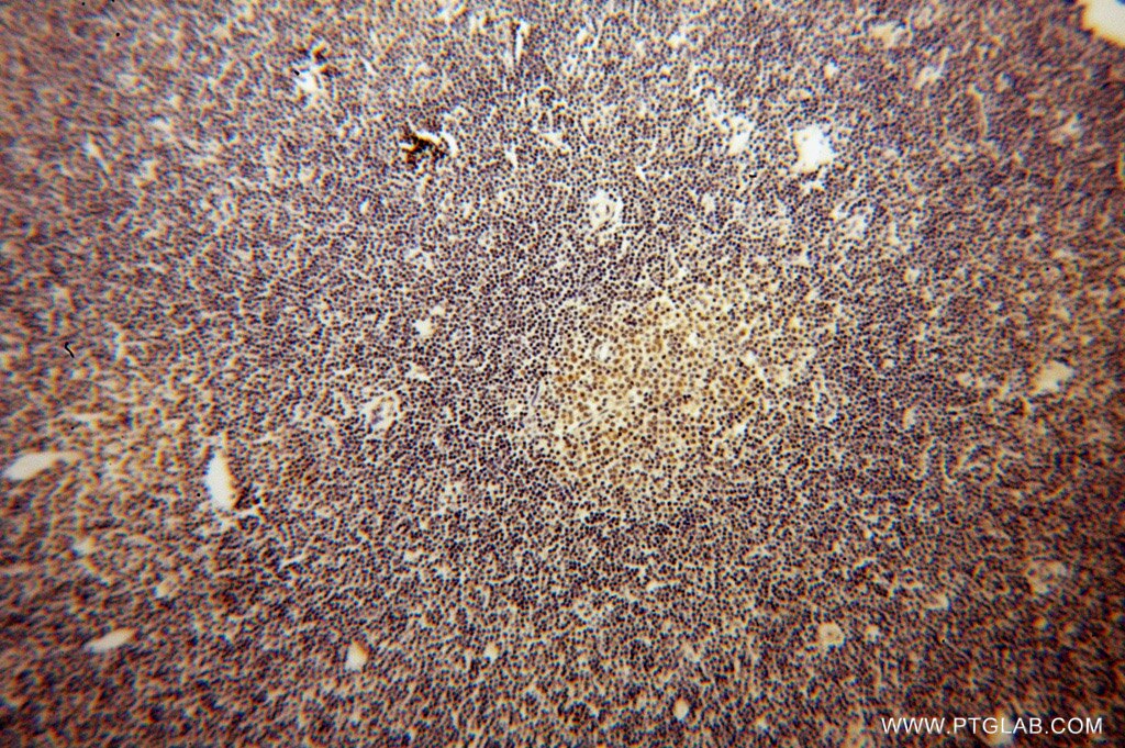 Immunohistochemistry (IHC) staining of human lymphoma tissue using ROD1 Polyclonal antibody (14027-1-AP)