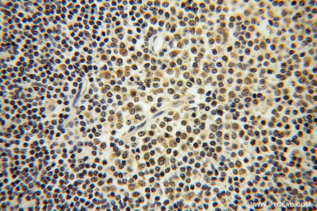 Immunohistochemistry (IHC) staining of human lymphoma tissue using ROD1 Polyclonal antibody (14027-1-AP)