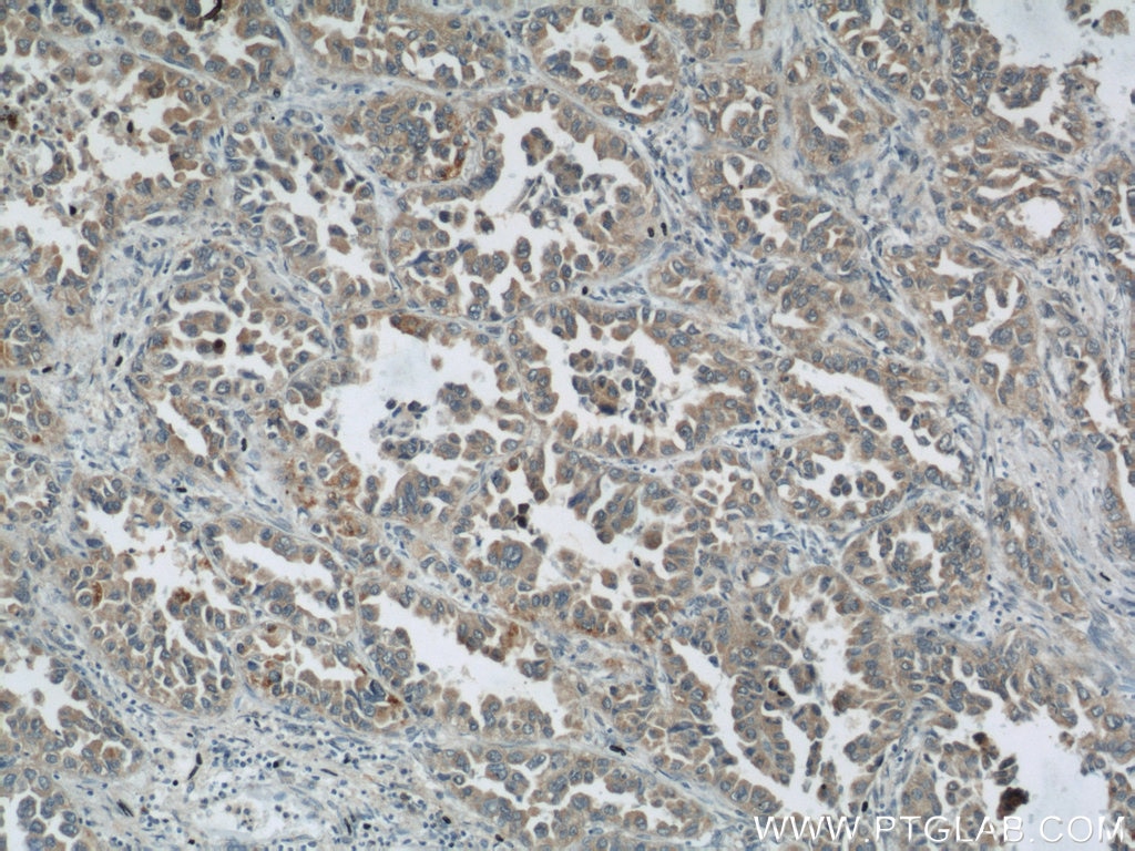 Immunohistochemistry (IHC) staining of human lung cancer tissue using ROMO1 Polyclonal antibody (24200-1-AP)