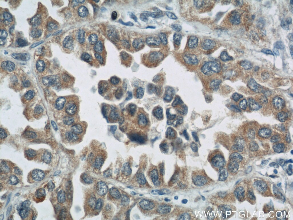 Immunohistochemistry (IHC) staining of human lung cancer tissue using ROMO1 Polyclonal antibody (24200-1-AP)