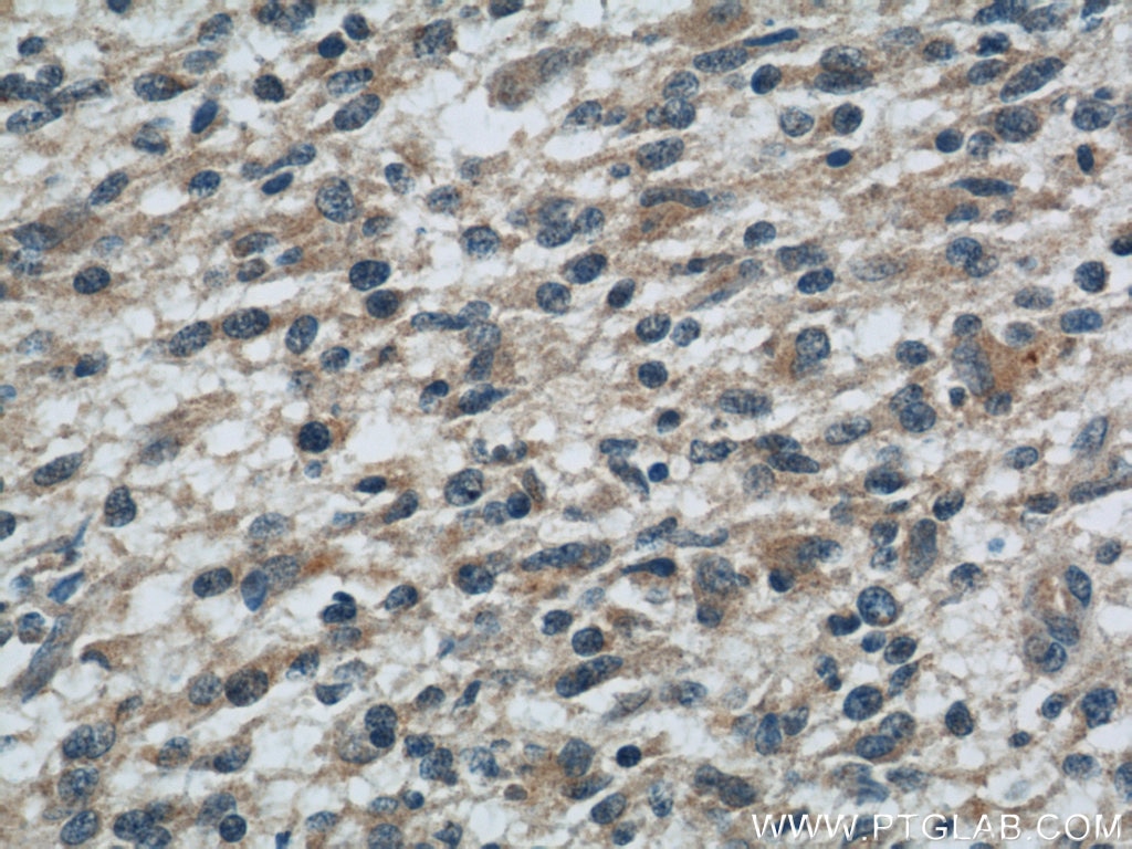 Immunohistochemistry (IHC) staining of human gliomas tissue using ROMO1 Polyclonal antibody (24200-1-AP)