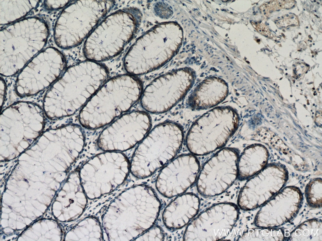 Immunohistochemistry (IHC) staining of human colon cancer tissue using ROPN1L Polyclonal antibody (12565-1-AP)