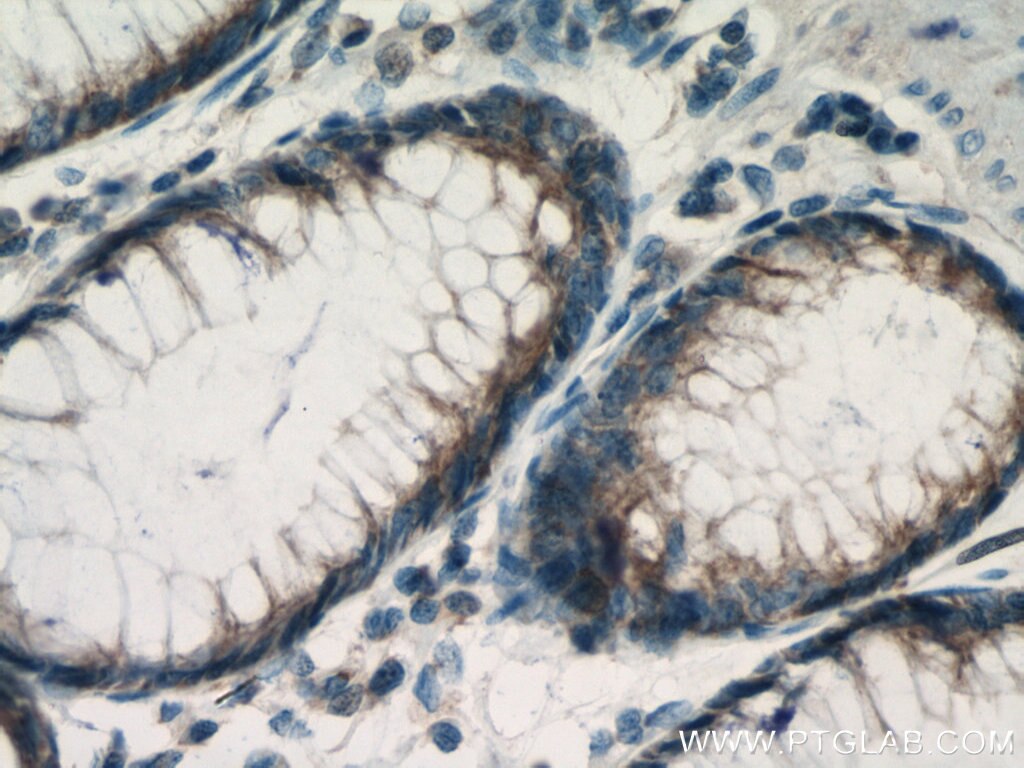 Immunohistochemistry (IHC) staining of human colon cancer tissue using ROPN1L Polyclonal antibody (12565-1-AP)