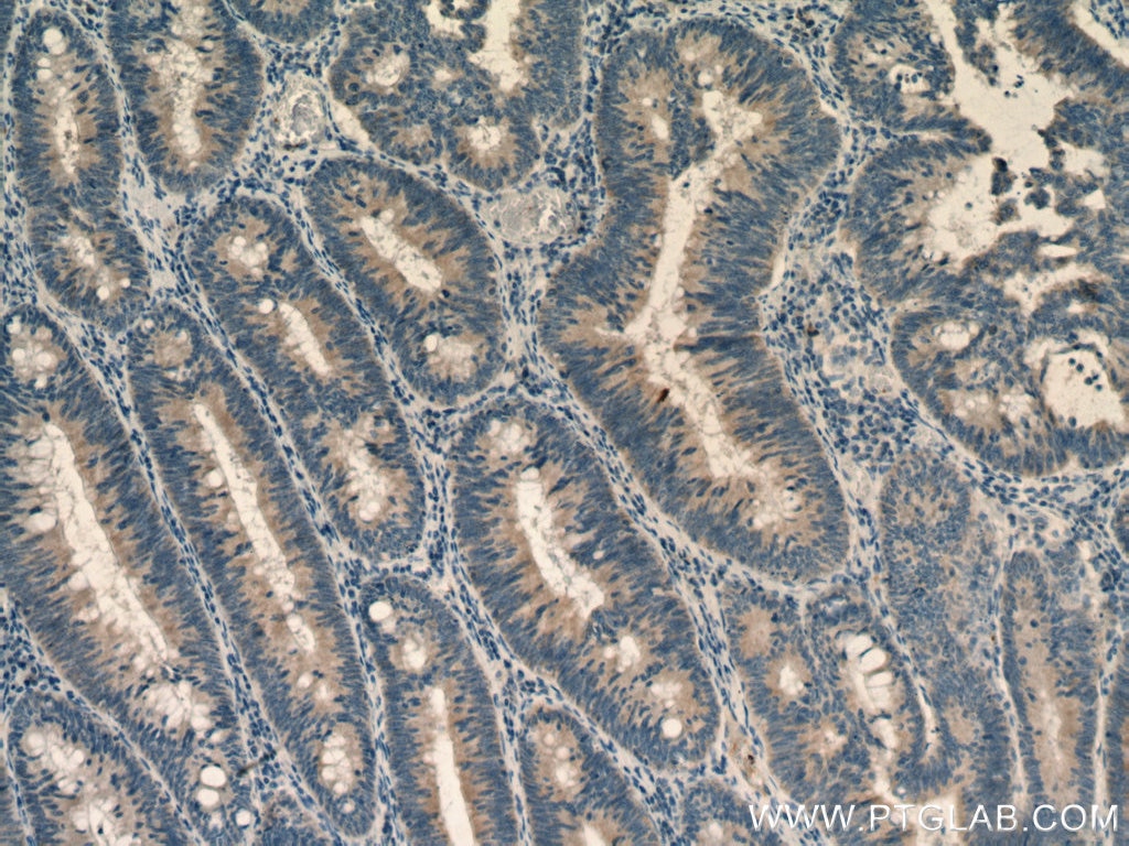 Immunohistochemistry (IHC) staining of human colon cancer tissue using ROPN1L Polyclonal antibody (12565-1-AP)