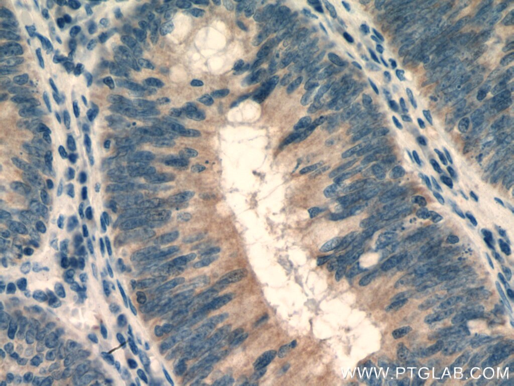 Immunohistochemistry (IHC) staining of human colon cancer tissue using ROPN1L Polyclonal antibody (12565-1-AP)