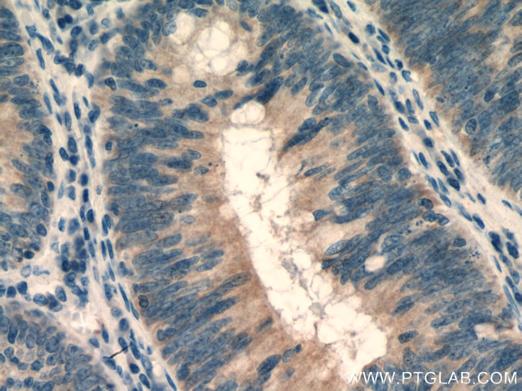 Immunohistochemistry (IHC) staining of human colon cancer tissue using ROPN1L Polyclonal antibody (12565-1-AP)