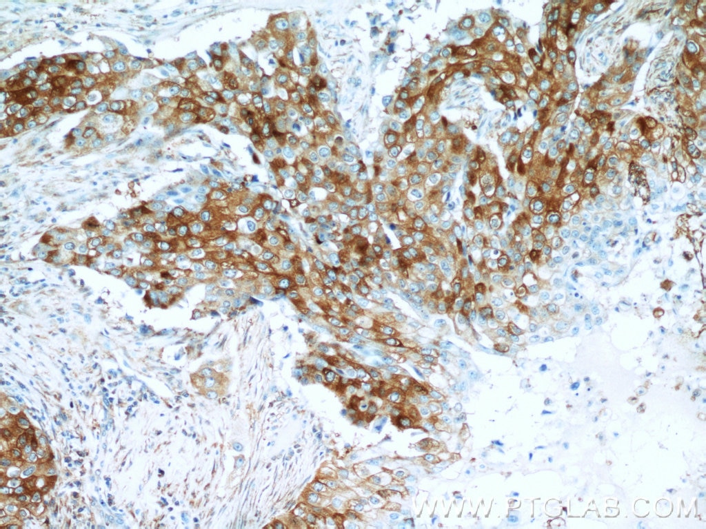 IHC staining of human breast cancer using 20629-1-AP