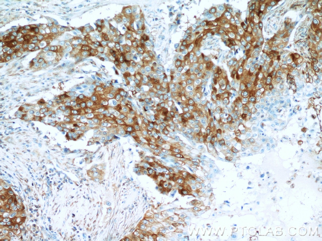 Immunohistochemistry (IHC) staining of human breast cancer tissue using ROR1 Polyclonal antibody (20629-1-AP)