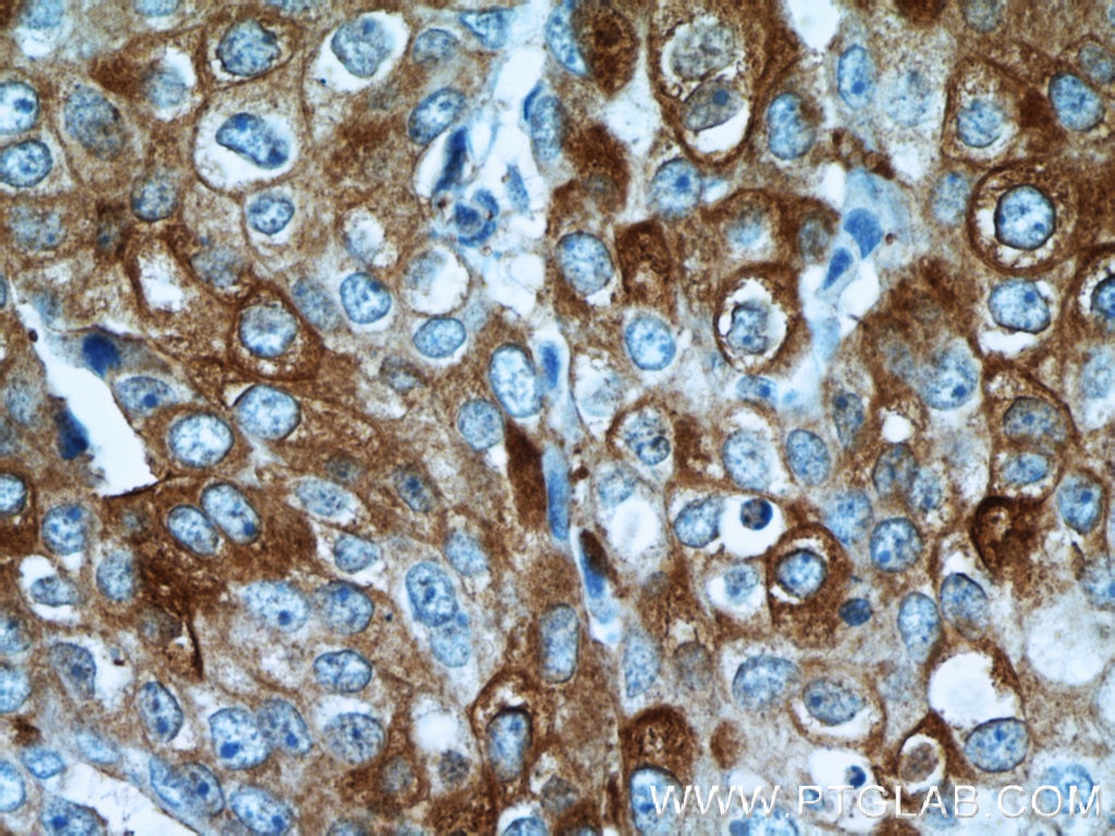 Immunohistochemistry (IHC) staining of human breast cancer tissue using ROR1 Polyclonal antibody (20629-1-AP)