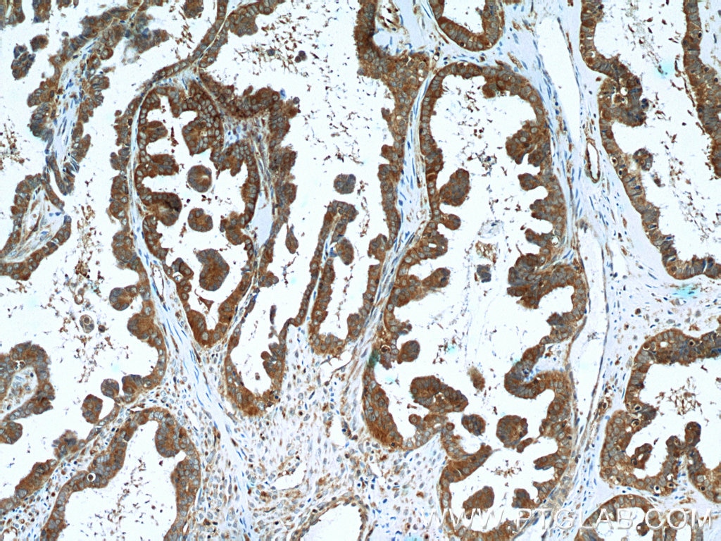 Immunohistochemistry (IHC) staining of human ovary tumor tissue using ROR1 Polyclonal antibody (20629-1-AP)
