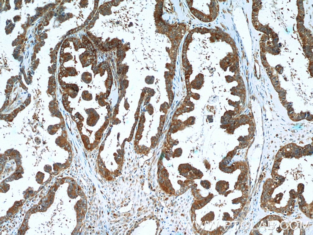 IHC staining of human ovary tumor using 20629-1-AP