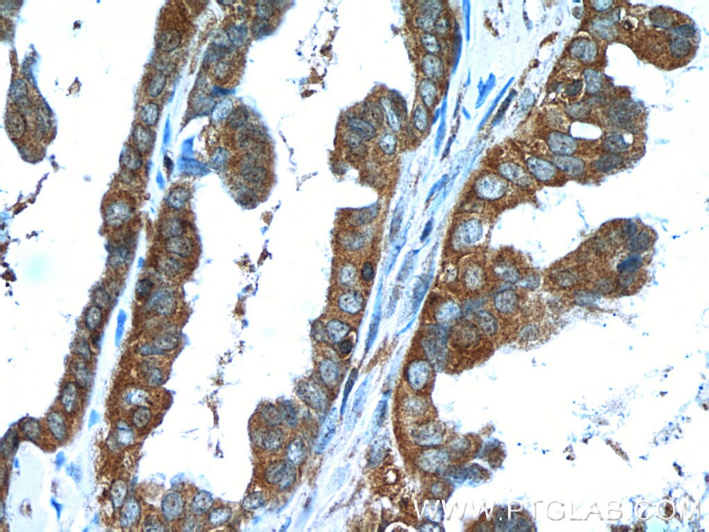 Immunohistochemistry (IHC) staining of human ovary tumor tissue using ROR1 Polyclonal antibody (20629-1-AP)