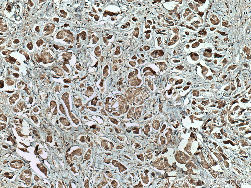 Immunohistochemistry (IHC) staining of human breast cancer tissue using ROR1 Monoclonal antibody (66923-1-Ig)
