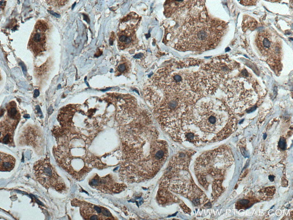 Immunohistochemistry (IHC) staining of human breast cancer tissue using ROR1 Monoclonal antibody (66923-1-Ig)