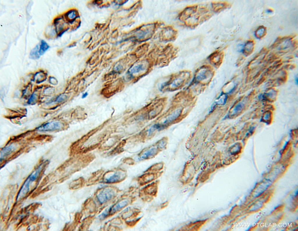 Immunohistochemistry (IHC) staining of human colon cancer tissue using Kazrin Polyclonal antibody (11572-1-AP)