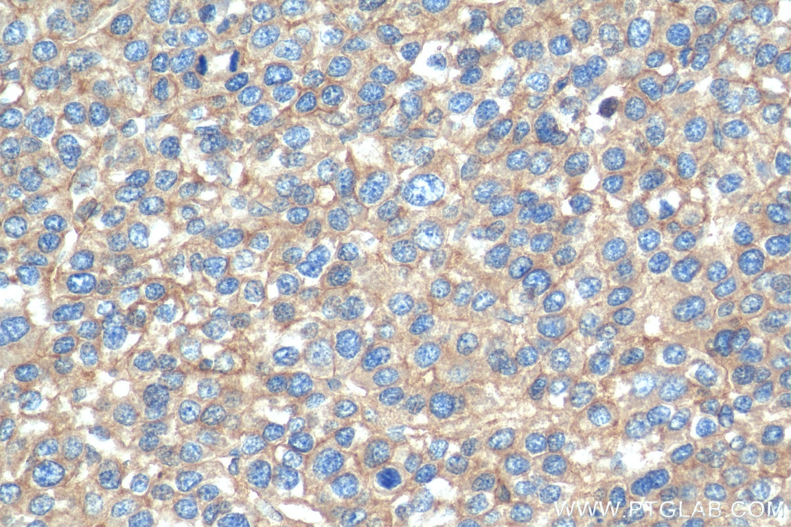 Immunohistochemistry (IHC) staining of human liver cancer tissue using RP2 Polyclonal antibody (14151-1-AP)