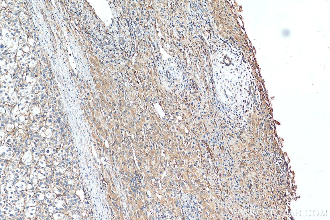 Immunohistochemistry (IHC) staining of human liver cancer tissue using RP2 Polyclonal antibody (14151-1-AP)